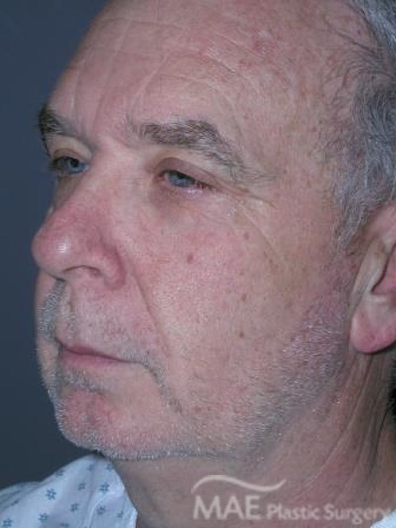 Facelift Before & After Gallery - Patient 258184 - Image 3