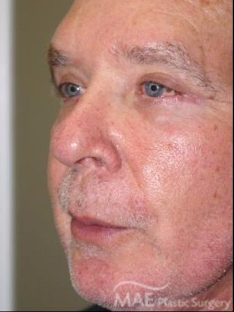 Facelift Before & After Gallery - Patient 258184 - Image 4
