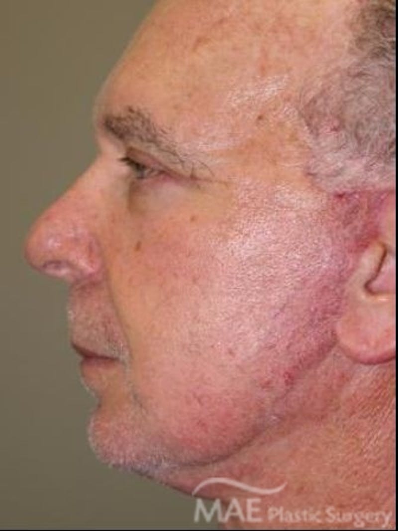 Facelift Before & After Gallery - Patient 258184 - Image 6