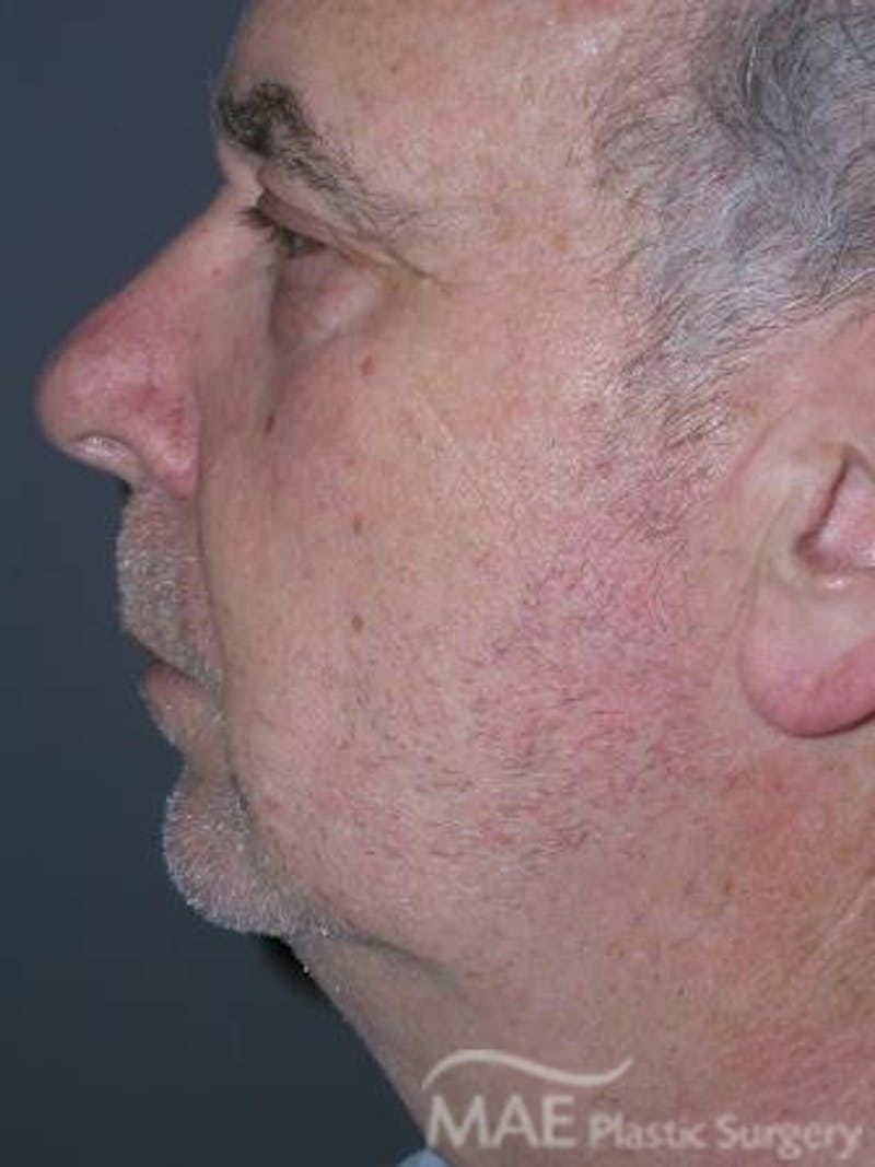 Facelift Before & After Gallery - Patient 258184 - Image 5