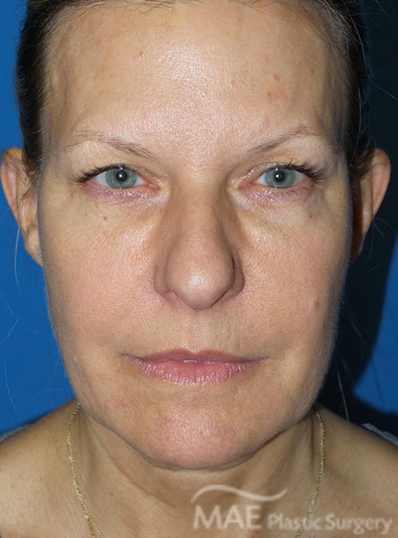 Facelift Before & After Gallery - Patient 355419 - Image 1
