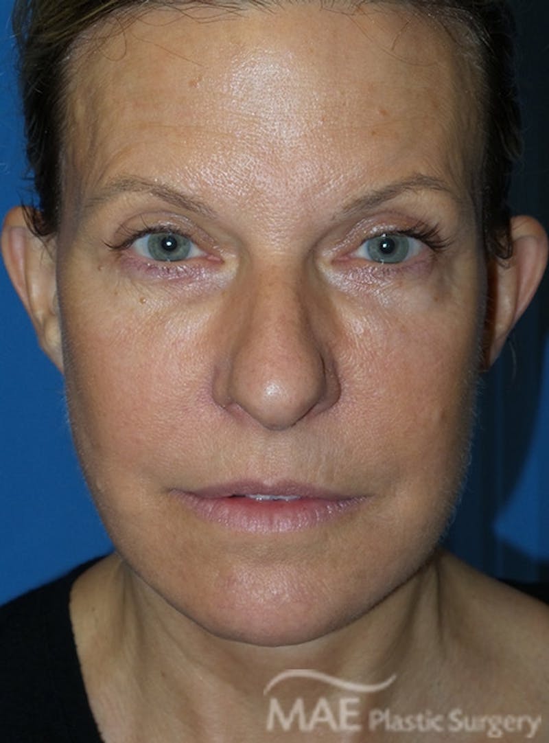 Facelift Before & After Gallery - Patient 355419 - Image 2
