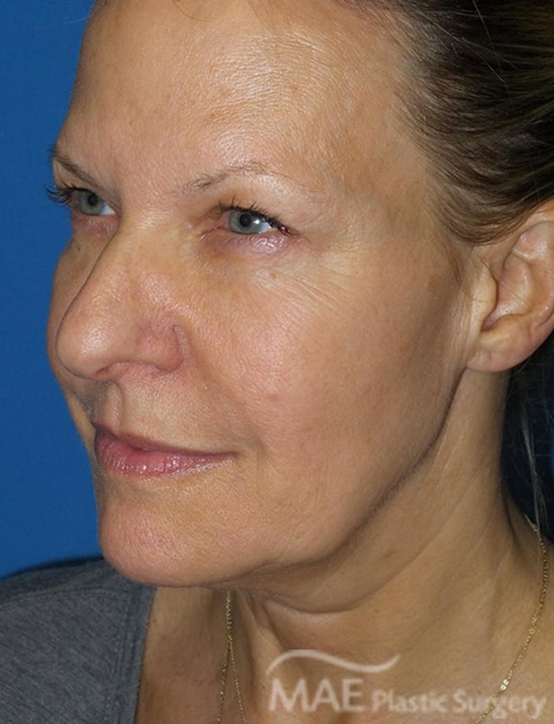 Facelift Before & After Gallery - Patient 355419 - Image 3