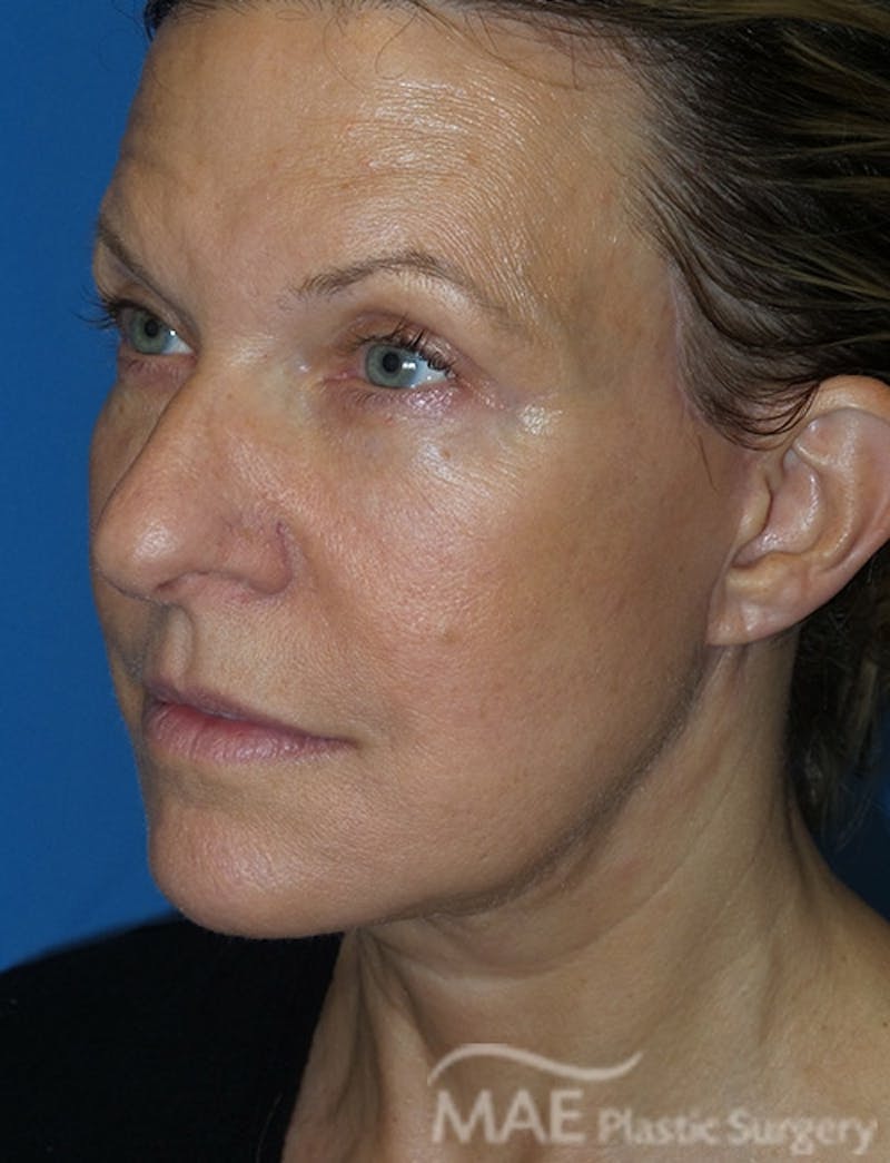 Facelift Before & After Gallery - Patient 355419 - Image 4