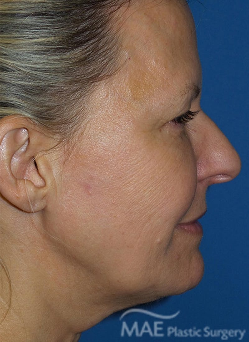 Facelift Before & After Gallery - Patient 355419 - Image 5