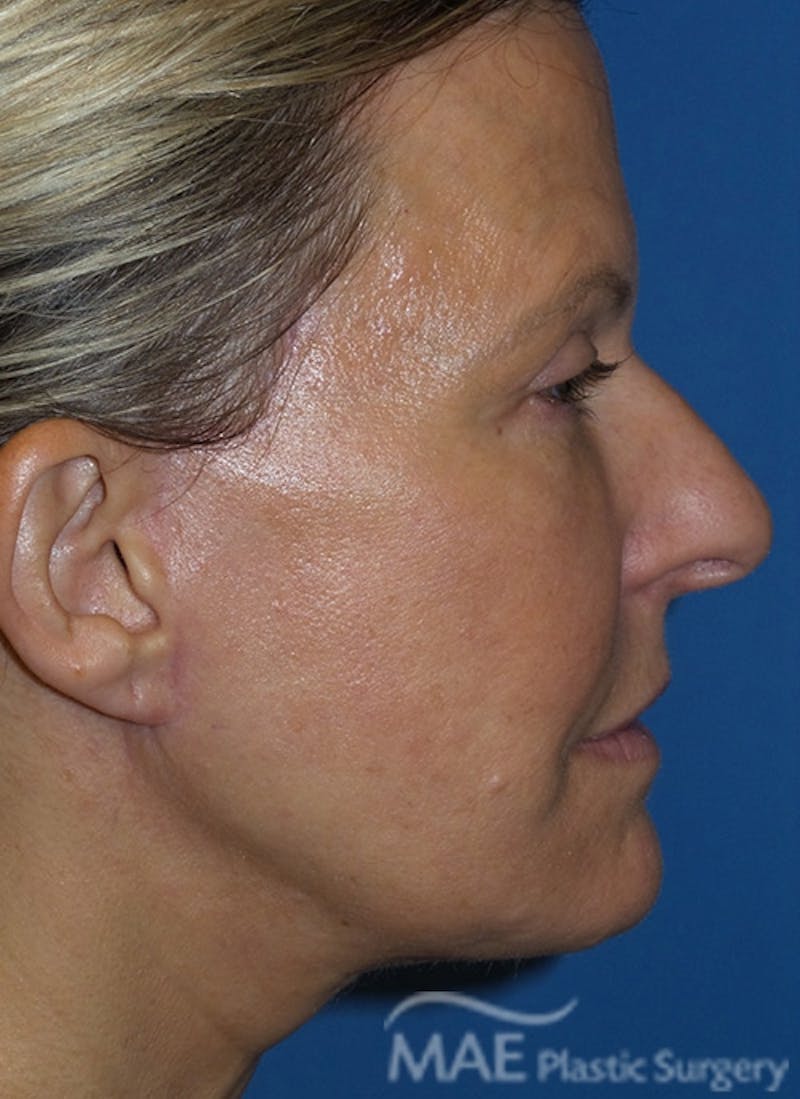 Facelift Before & After Gallery - Patient 355419 - Image 6