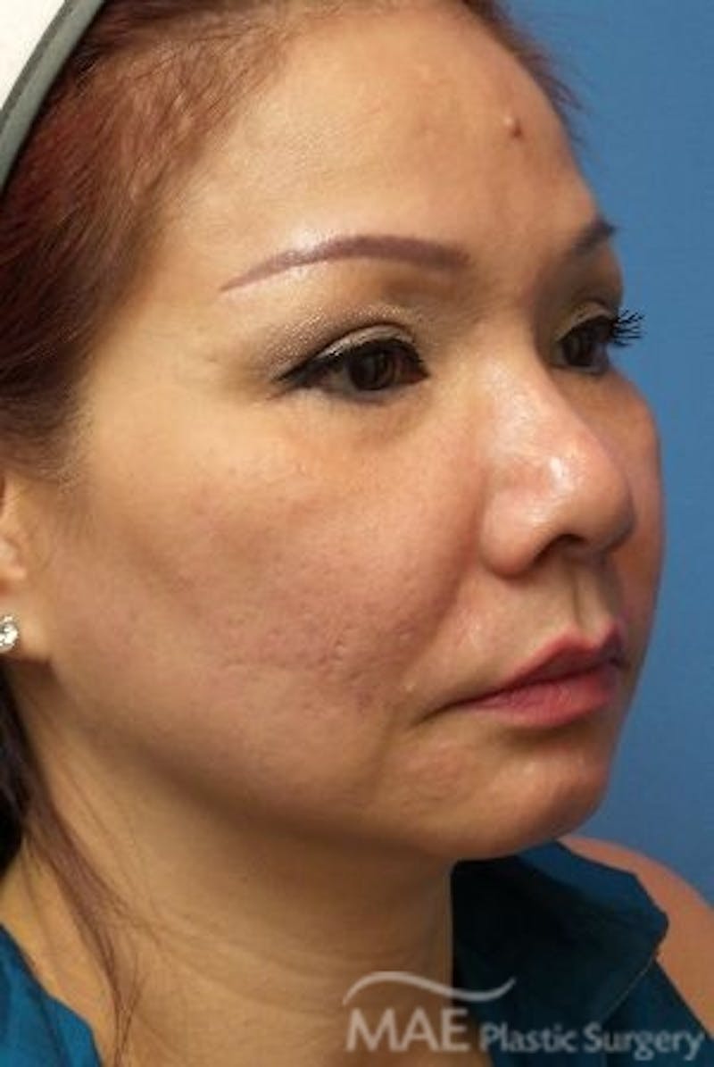 Facelift Before & After Gallery - Patient 324442 - Image 3