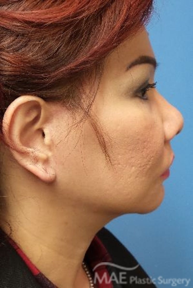Facelift Before & After Gallery - Patient 324442 - Image 6