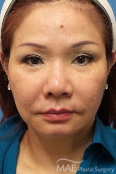 Facelift Before & After Gallery - Patient 324442 - Image 1