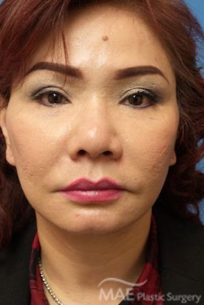 Facelift Before & After Gallery - Patient 324442 - Image 2