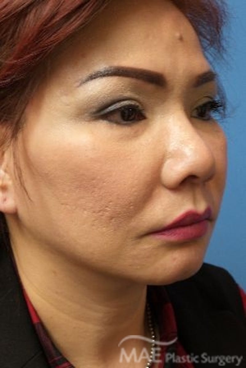 Facelift Before & After Gallery - Patient 324442 - Image 4