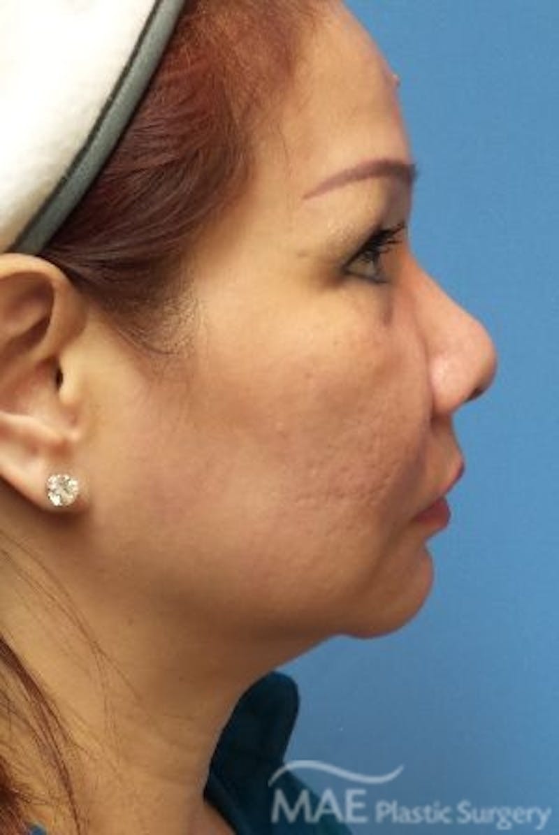 Facelift Before & After Gallery - Patient 324442 - Image 5