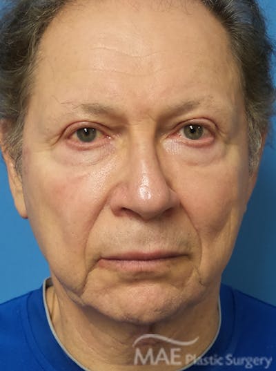 Facelift Before & After Gallery - Patient 222274 - Image 1