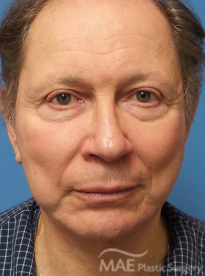 Facelift Before & After Gallery - Patient 222274 - Image 2
