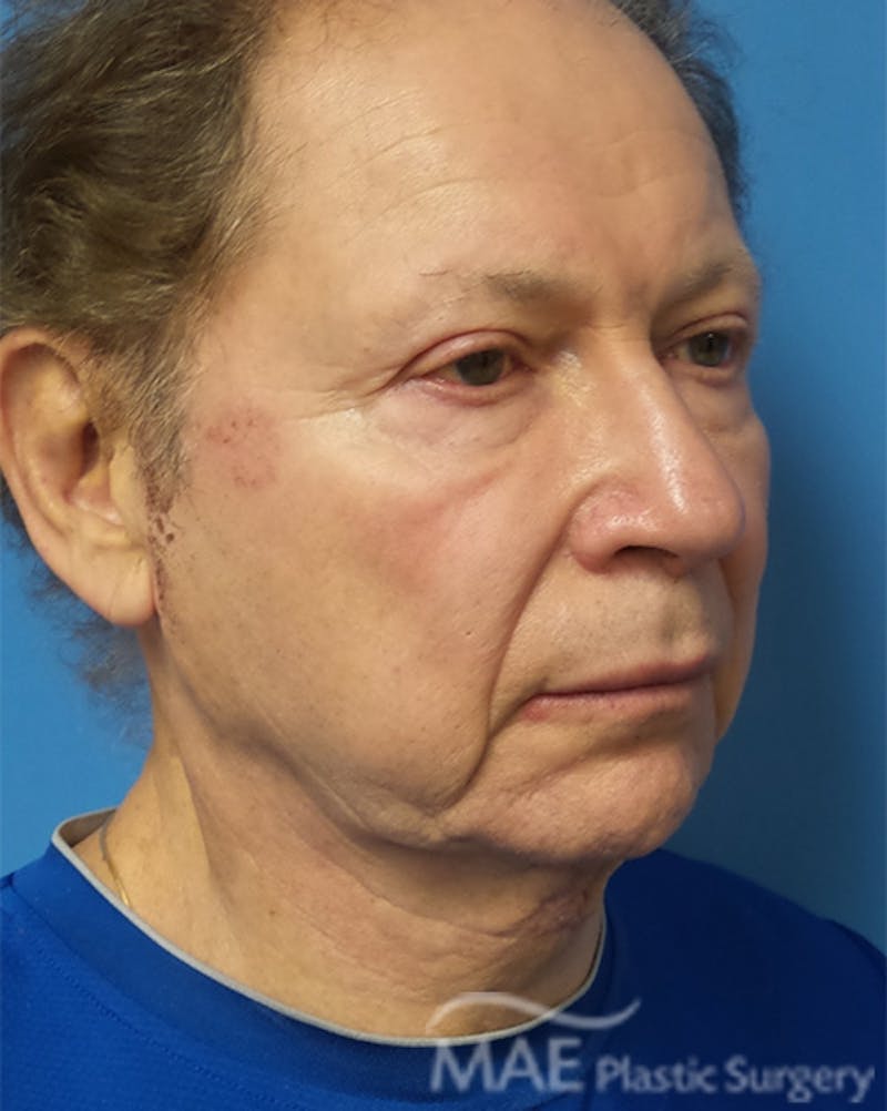 Facelift Before & After Gallery - Patient 222274 - Image 3
