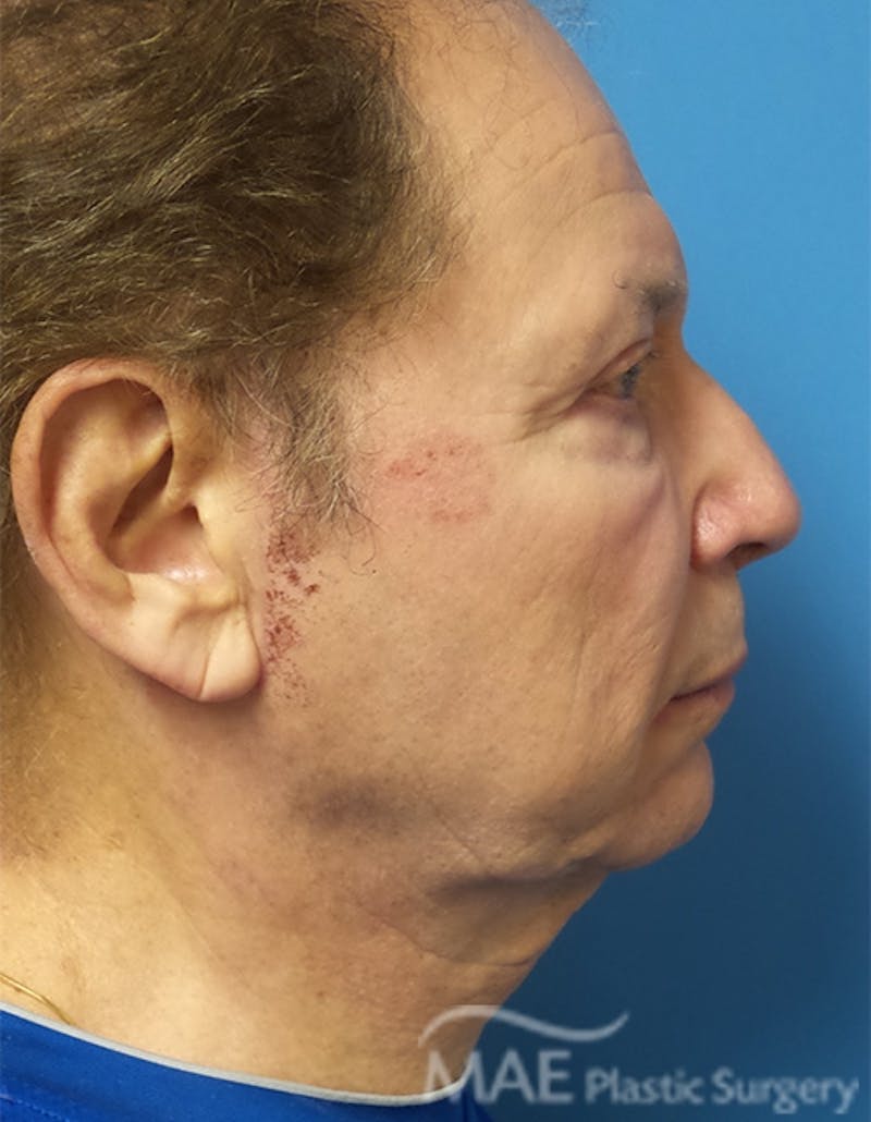 Facelift Before & After Gallery - Patient 222274 - Image 5