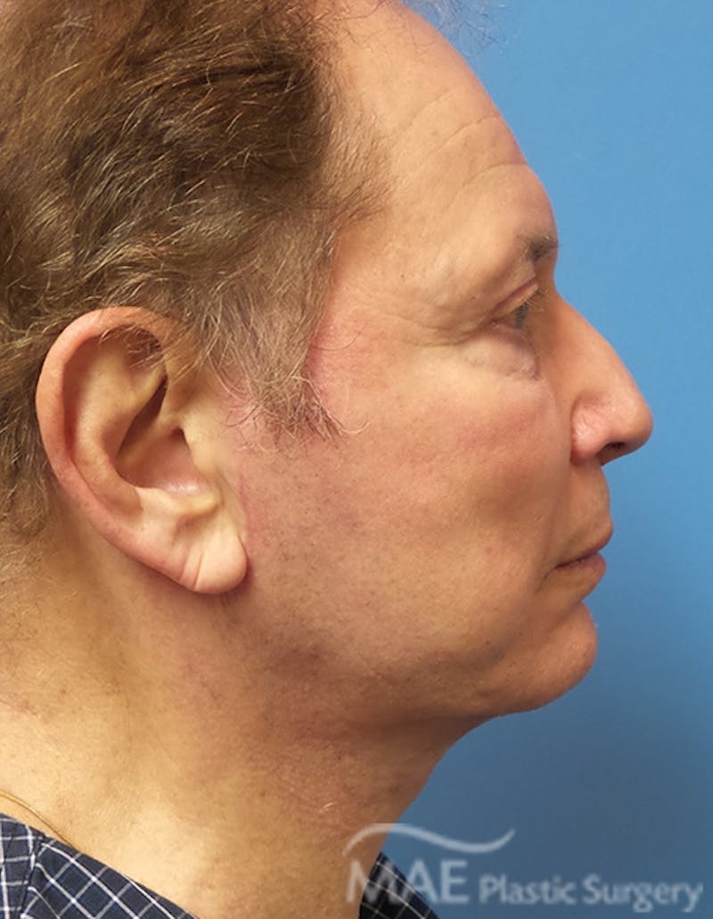 Facelift Before & After Gallery - Patient 222274 - Image 6