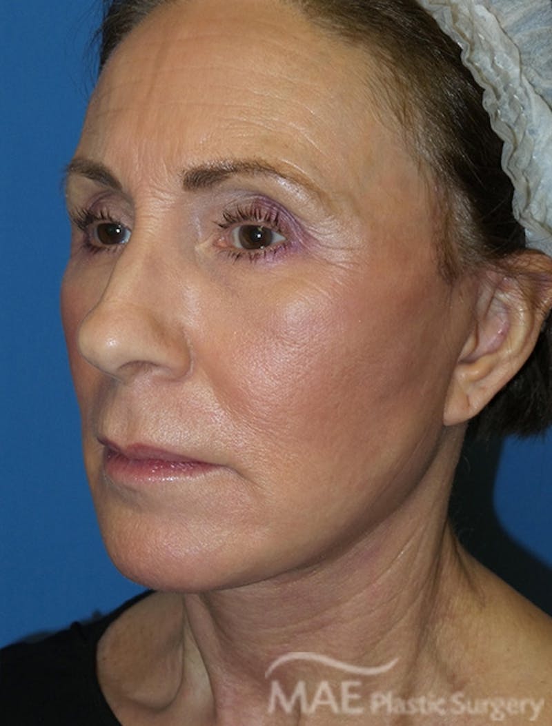 Facelift Before & After Gallery - Patient 362415 - Image 4