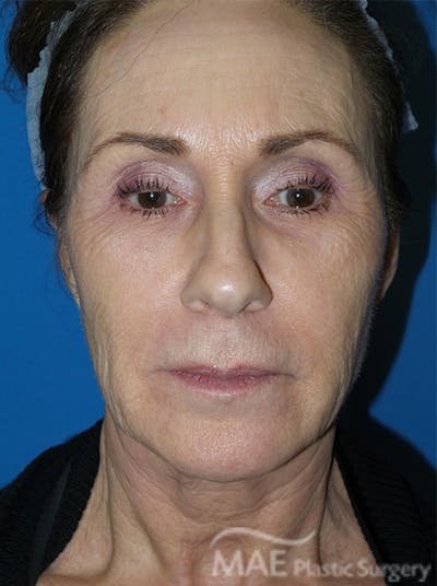Facelift Before & After Gallery - Patient 362415 - Image 1