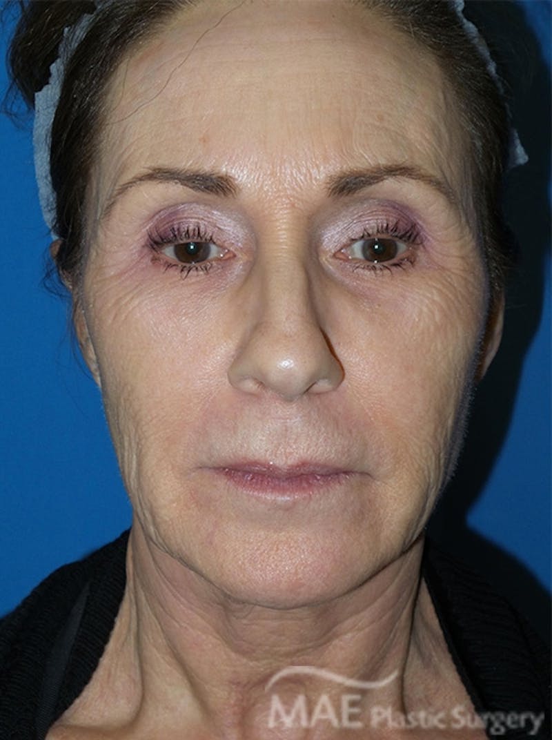 Facelift Before & After Gallery - Patient 362415 - Image 1