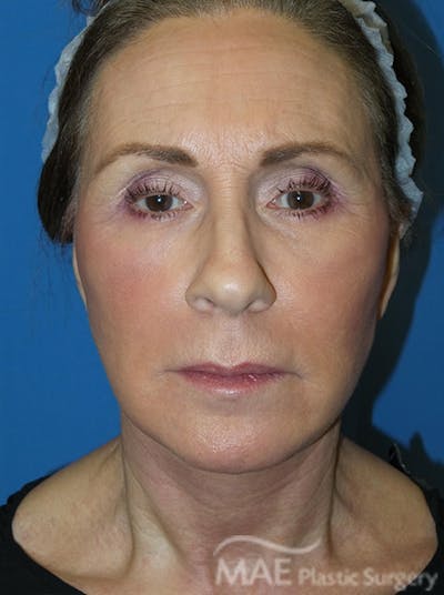 Facelift Before & After Gallery - Patient 362415 - Image 2
