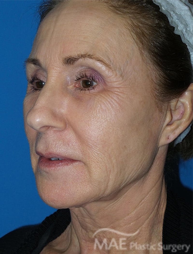 Facelift Before & After Gallery - Patient 362415 - Image 3