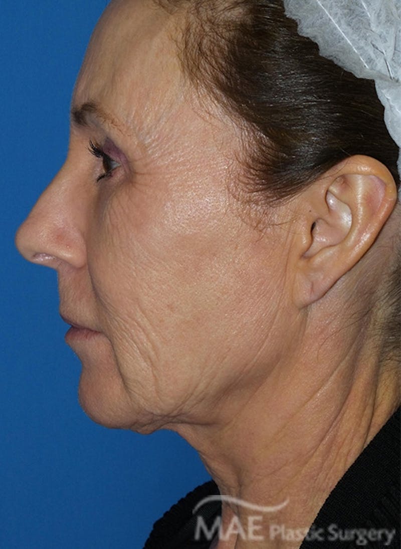 Facelift Before & After Gallery - Patient 362415 - Image 5