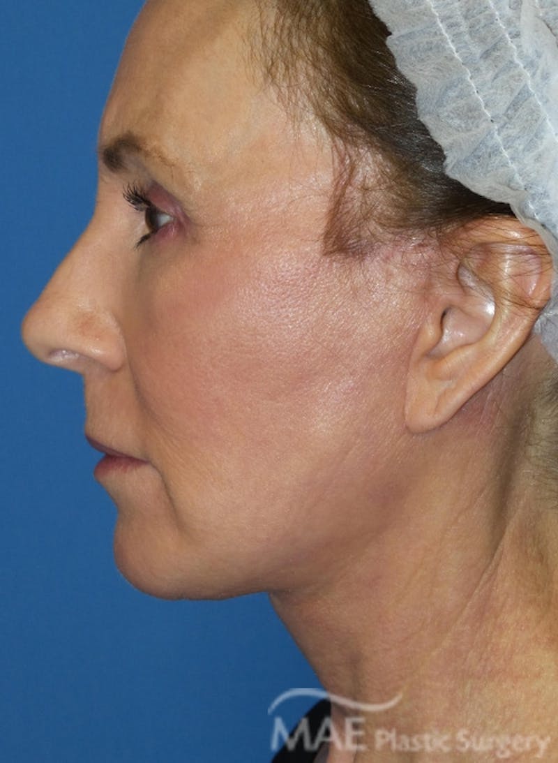 Facelift Before & After Gallery - Patient 362415 - Image 6