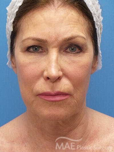 Facelift Before & After Gallery - Patient 346321 - Image 1
