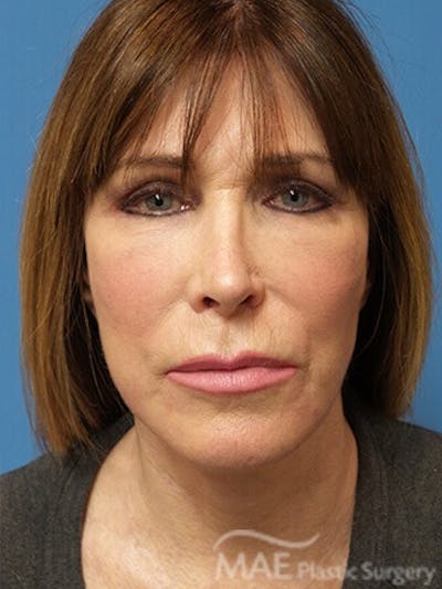 Facelift Before & After Gallery - Patient 346321 - Image 2