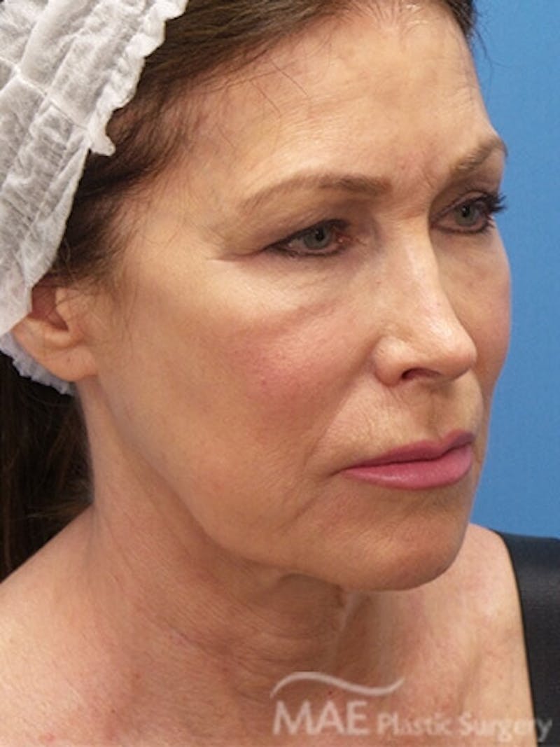 Facelift Before & After Gallery - Patient 346321 - Image 3