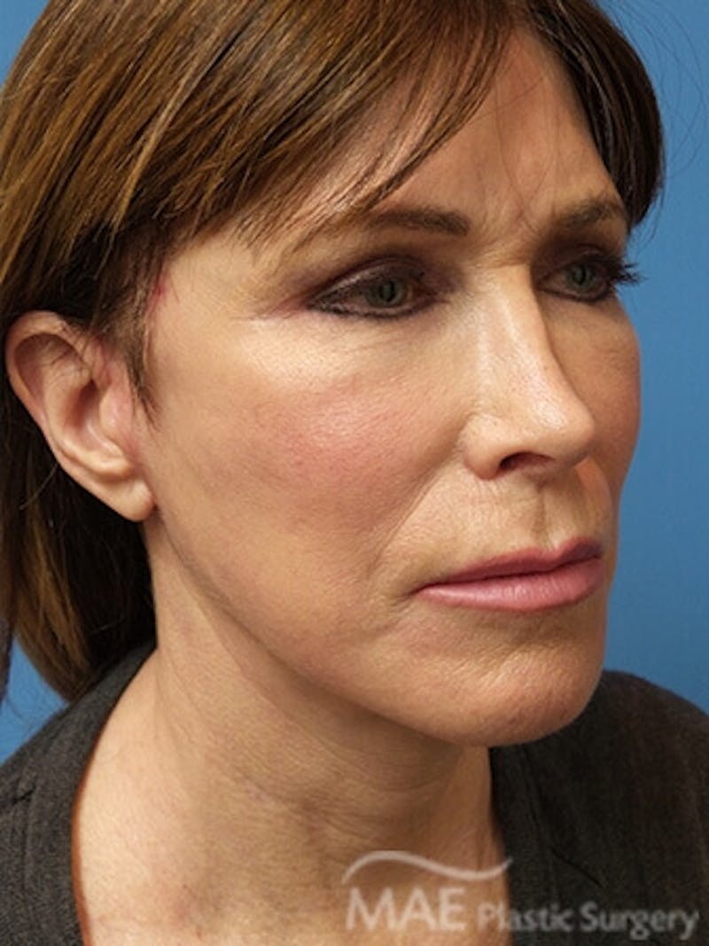 Facelift Before & After Gallery - Patient 346321 - Image 4