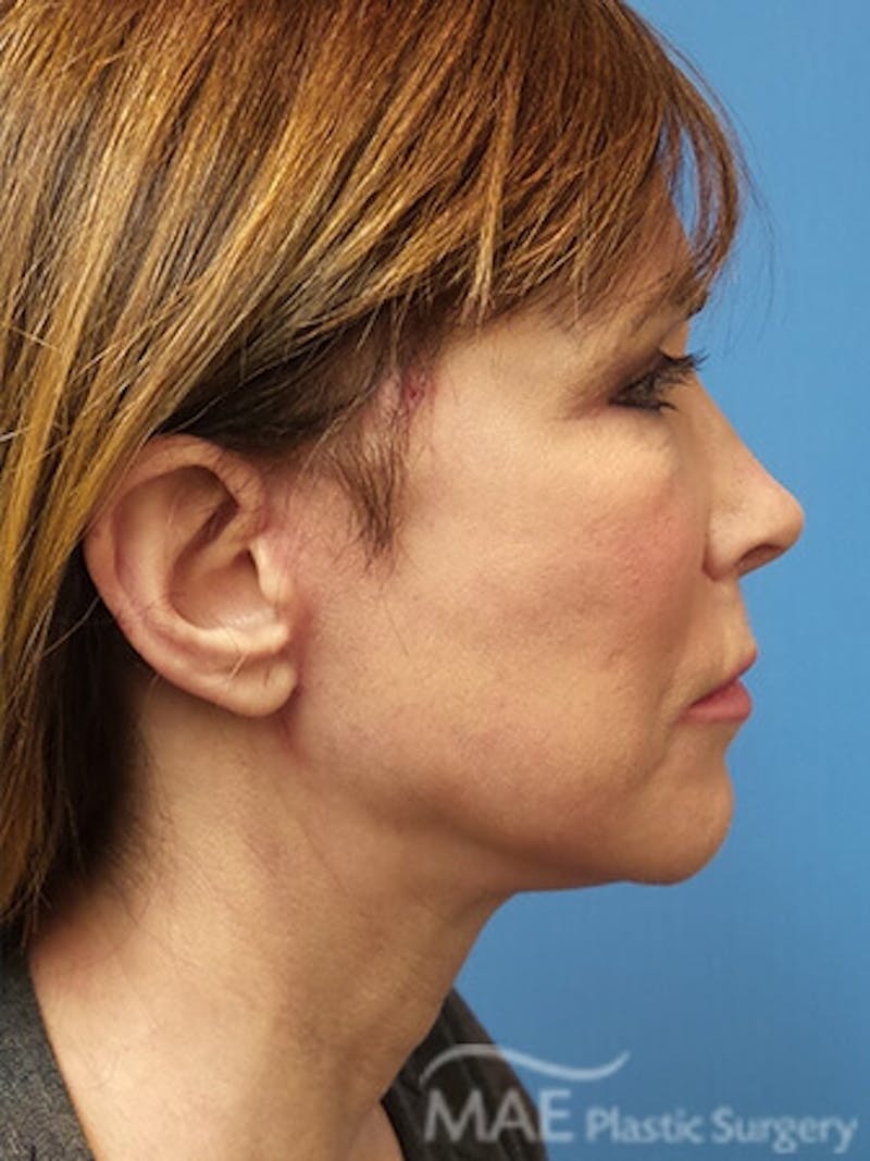 Facelift Before & After Gallery - Patient 346321 - Image 6