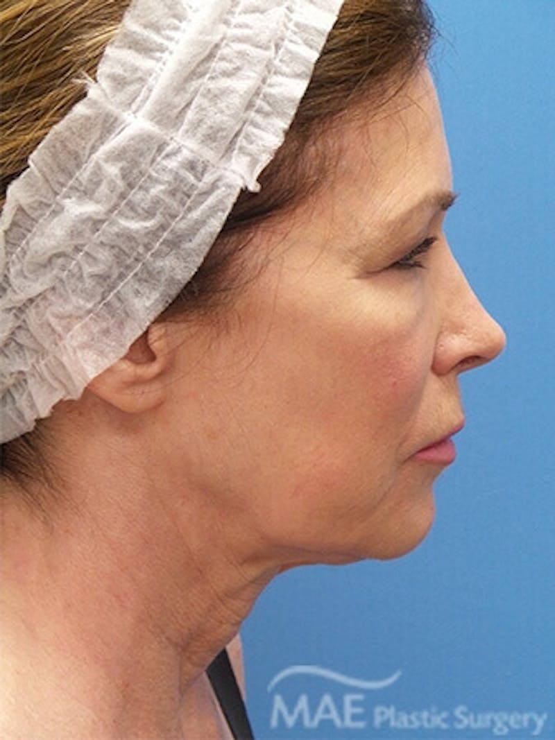 Facelift Before & After Gallery - Patient 346321 - Image 5