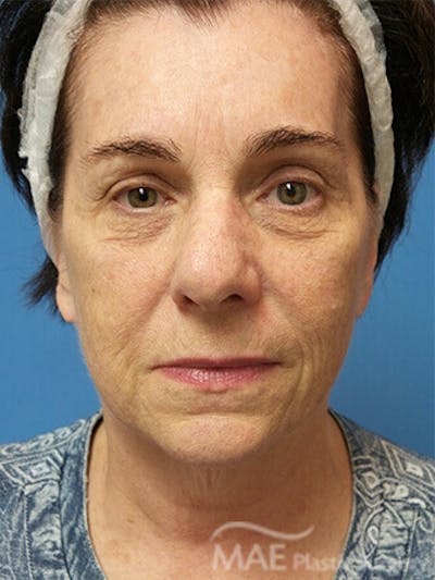 Facelift Before & After Gallery - Patient 278439 - Image 1