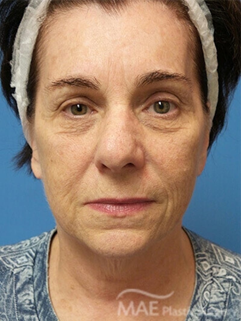 Facelift Before & After Gallery - Patient 278439 - Image 1