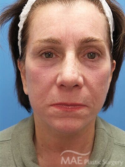 Facelift Before & After Gallery - Patient 278439 - Image 2
