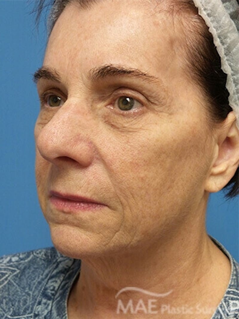 Facelift Before & After Gallery - Patient 278439 - Image 3