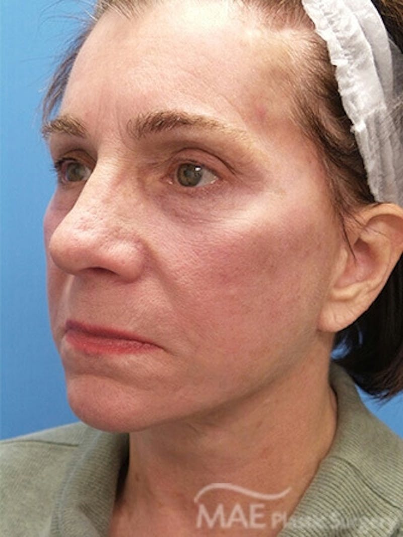 Facelift Before & After Gallery - Patient 278439 - Image 4