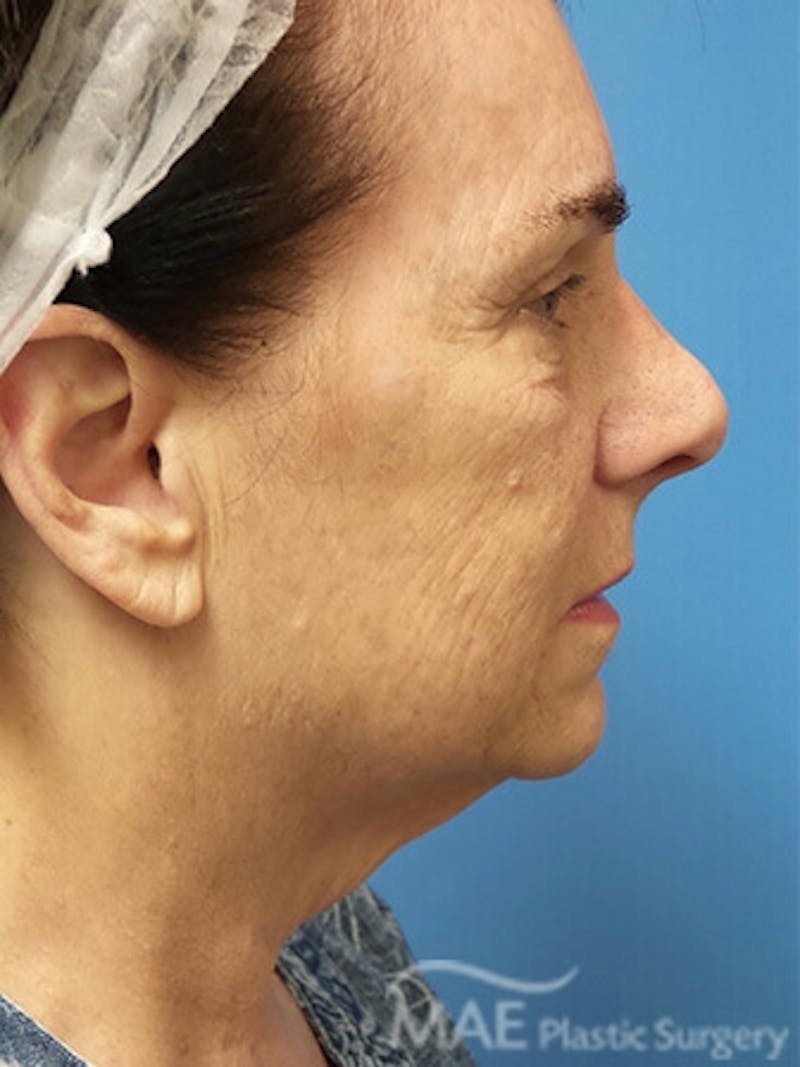 Facelift Before & After Gallery - Patient 278439 - Image 5