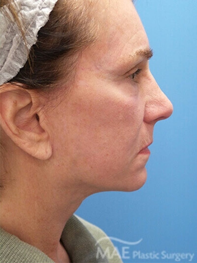 Facelift Before & After Gallery - Patient 278439 - Image 6