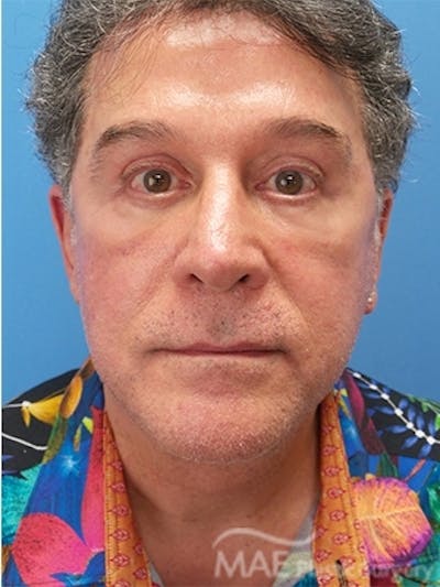 Facelift Before & After Gallery - Patient 346152 - Image 2