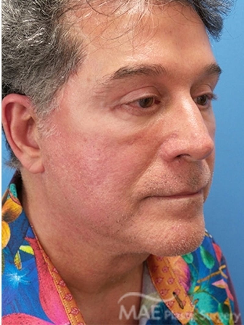 Facelift Before & After Gallery - Patient 346152 - Image 4