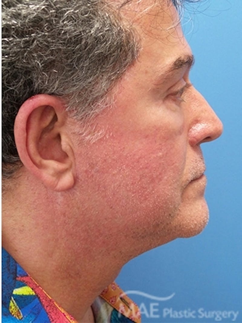 Facelift Before & After Gallery - Patient 346152 - Image 6