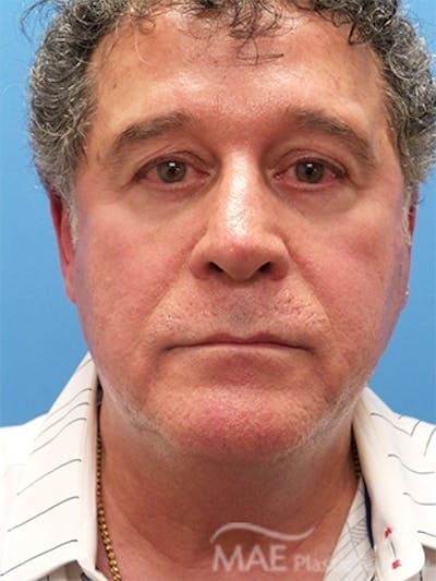 Facelift Before & After Gallery - Patient 346152 - Image 1