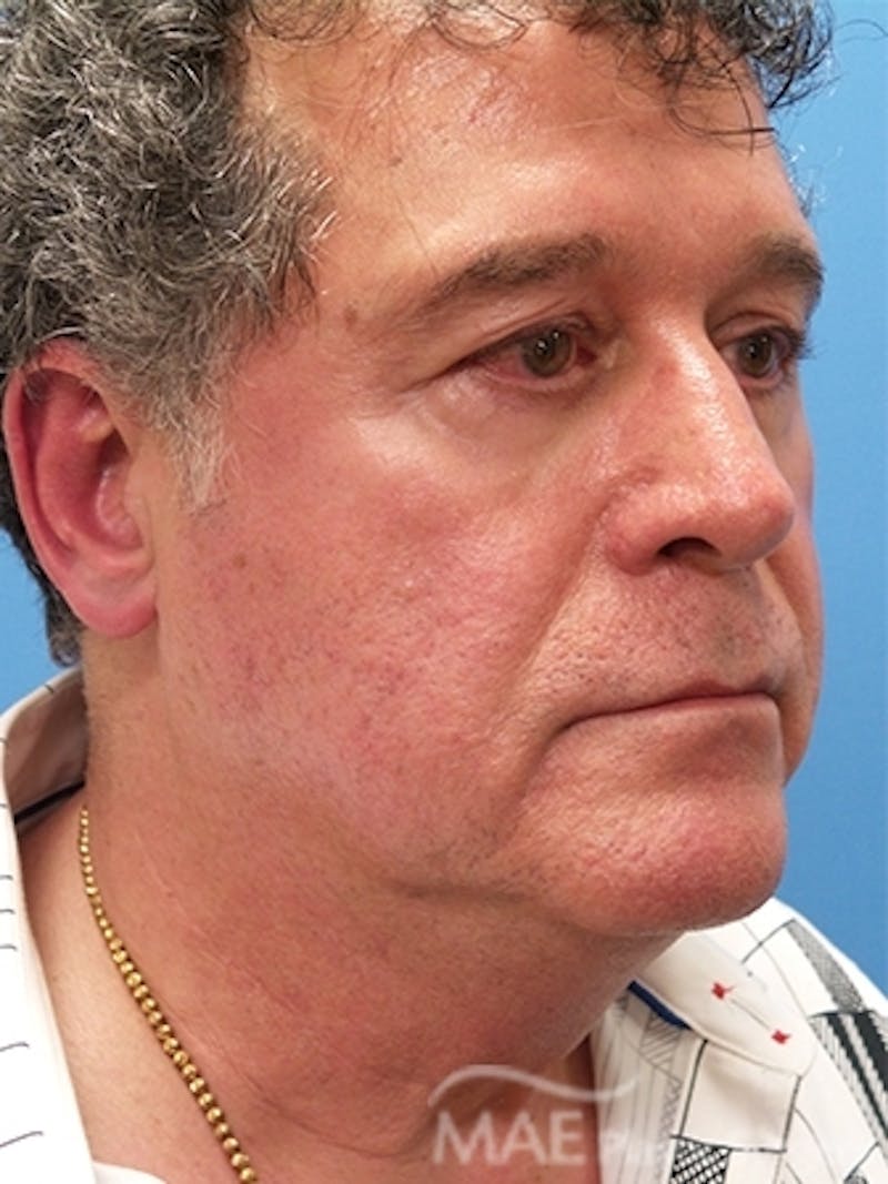 Facelift Before & After Gallery - Patient 346152 - Image 3