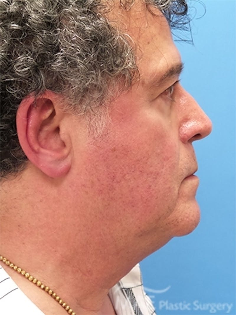 Facelift Before & After Gallery - Patient 346152 - Image 5