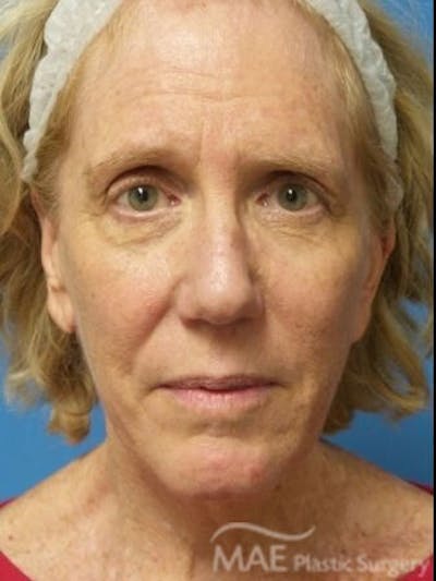 Facelift Before & After Gallery - Patient 353757 - Image 1