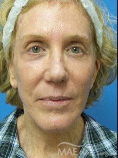 Facelift Before & After Gallery - Patient 353757 - Image 2