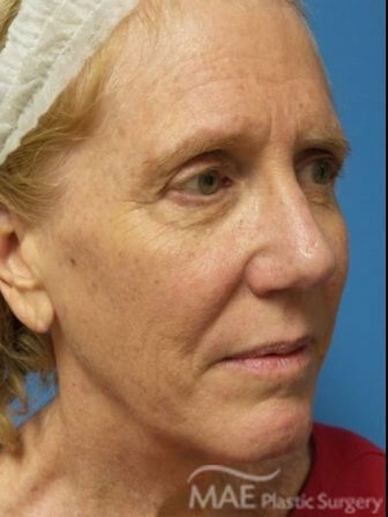 Facelift Before & After Gallery - Patient 353757 - Image 3